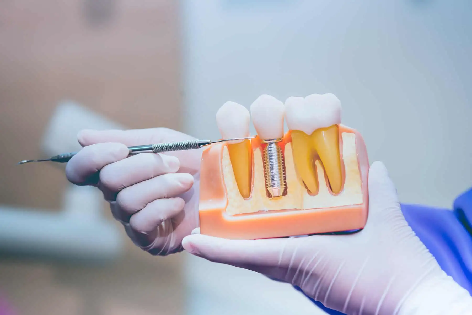 Dental implant restoration at Jayhawk Dental