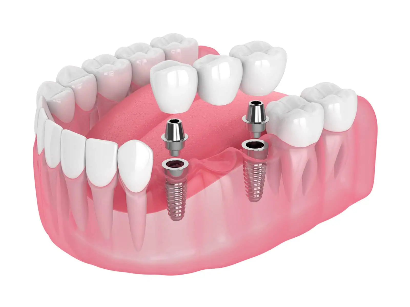 Implant-supported dentures fitted with modern materials