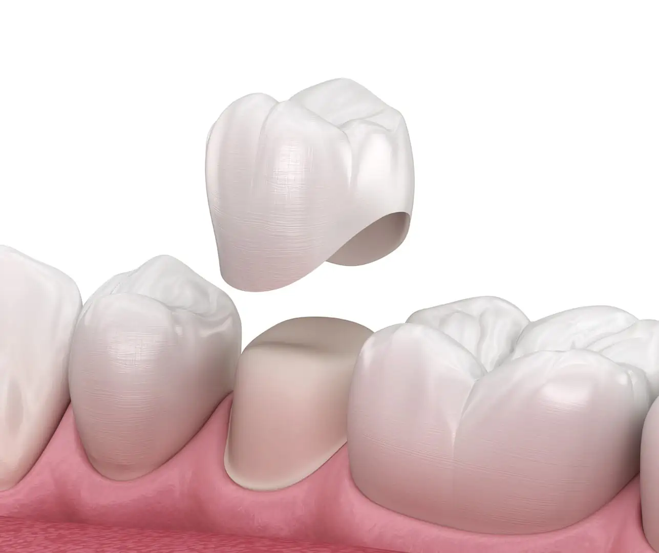 Natural-looking dental crown restoration