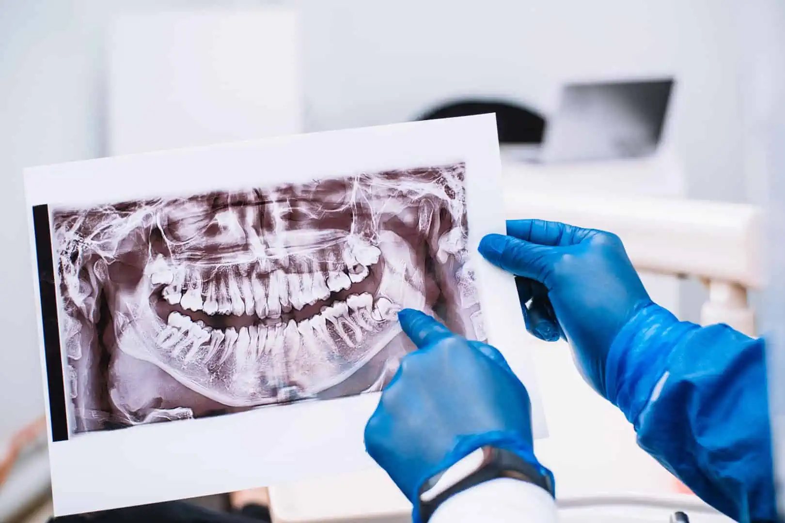 Wisdom tooth extraction handled in-office